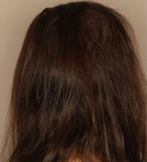 Detuve la pérdida de cabello con Verdexedil