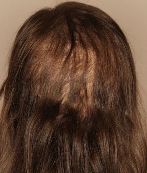 pérdida de cabello antes de usar el spray verdexedil
